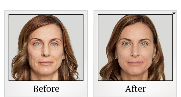 Before and After Photo 8 of Sculptra® treatment at SF Bay Cosmetic Surgery Medical Group in San Ramon