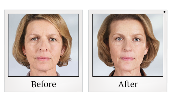 Before and After Photo 9 of Sculptra® treatment at SF Bay Cosmetic Surgery Medical Group in San Ramon
