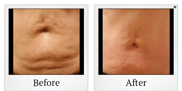 Before and After Photo 9 of Thermage® treatment at SF Bay Cosmetic Surgery Medical Group in San Ramon