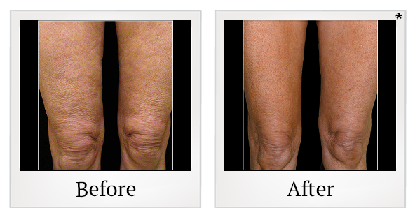 Before and After Photo 10 of Thermage® treatment at SF Bay Cosmetic Surgery Medical Group in San Ramon