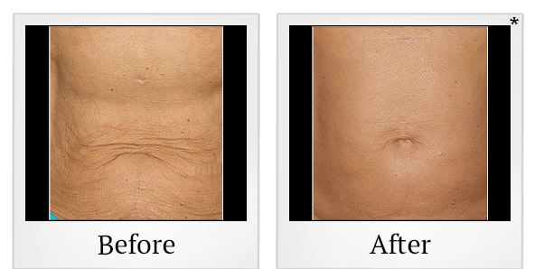 Before and After Photo 11 of Thermage® treatment at SF Bay Cosmetic Surgery Medical Group in San Ramon