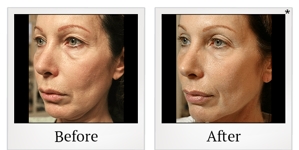 Before and After Photo 1 of Thermage® treatment at SF Bay Cosmetic Surgery Medical Group in San Ramon