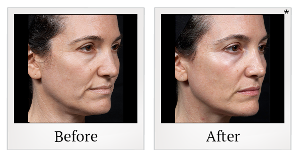 Before and After Photo 2 of Thermage® treatment at SF Bay Cosmetic Surgery Medical Group in San Ramon