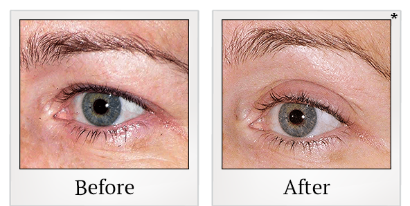 Before and After Photo 3 of Thermage® treatment at SF Bay Cosmetic Surgery Medical Group in San Ramon
