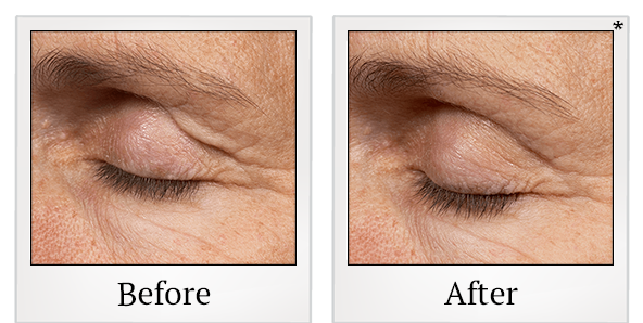 Before and After Photo 4 of Thermage® treatment at SF Bay Cosmetic Surgery Medical Group in San Ramon