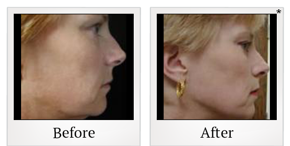 Before and After Photo 5 of Thermage® treatment at SF Bay Cosmetic Surgery Medical Group in San Ramon