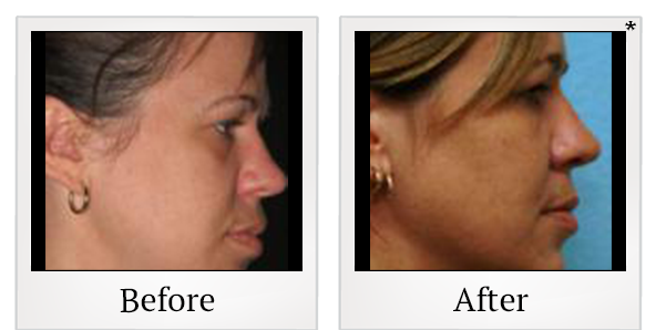 Before and After Photo 6 of Thermage® treatment at SF Bay Cosmetic Surgery Medical Group in San Ramon
