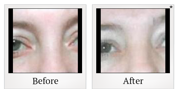 Before and After Photo 7 of Thermage® treatment at SF Bay Cosmetic Surgery Medical Group in San Ramon