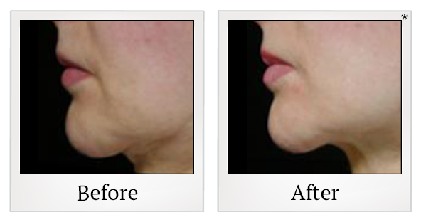 Before and After Photo 8 of Thermage® treatment at SF Bay Cosmetic Surgery Medical Group in San Ramon