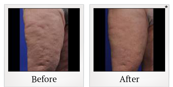 Before and After Photo 5 of ThermiSmooth® treatment at SF Bay Cosmetic Surgery Medical Group in San Ramon