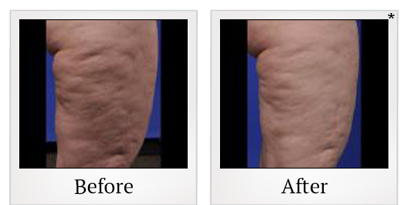 Before and After Photo 6 of ThermiSmooth® treatment at SF Bay Cosmetic Surgery Medical Group in San Ramon