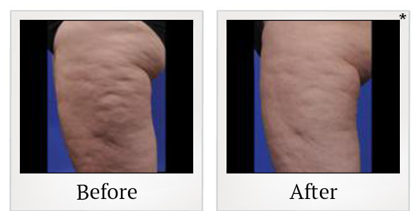 Before and After Photo 7 of ThermiSmooth® treatment at SF Bay Cosmetic Surgery Medical Group in San Ramon