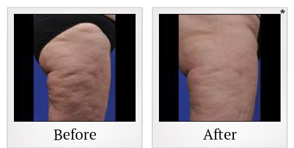 Before and After Photo 8 of ThermiSmooth® treatment at SF Bay Cosmetic Surgery Medical Group in San Ramon