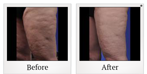 Before and After Photo 9 of ThermiSmooth® treatment at SF Bay Cosmetic Surgery Medical Group in San Ramon