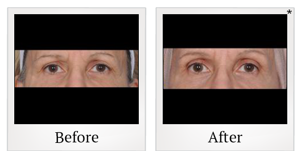 Before and After Photo 1 of ThermiSmooth® treatment at SF Bay Cosmetic Surgery Medical Group in San Ramon