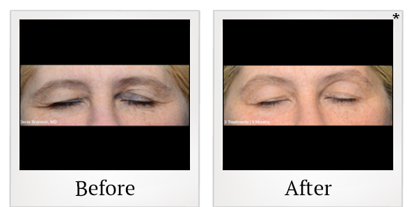 Before and After Photo 2 of ThermiSmooth® treatment at SF Bay Cosmetic Surgery Medical Group in San Ramon
