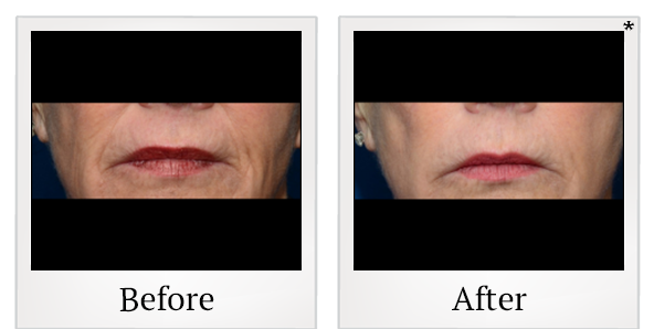 Before and After Photo 3 of ThermiSmooth® treatment at SF Bay Cosmetic Surgery Medical Group in San Ramon