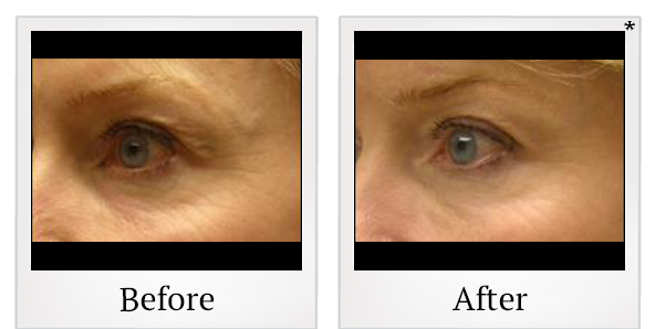 Before and After Photo 4 of ThermiSmooth® treatment at SF Bay Cosmetic Surgery Medical Group in San Ramon