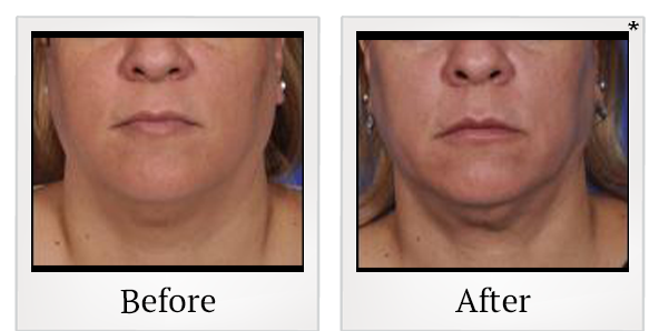 Before and After Photo 1 of Thermitight® treatment at SF Bay Cosmetic Surgery Medical Group in San Ramon