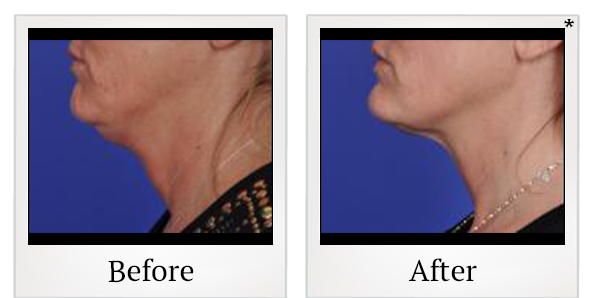 Before and After Photo 2 of Thermitight® treatment at SF Bay Cosmetic Surgery Medical Group in San Ramon