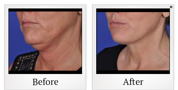 Before and After Photo 3 of Thermitight® treatment at SF Bay Cosmetic Surgery Medical Group in San Ramon