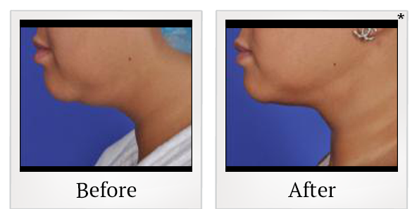 Before and After Photo 4 of Thermitight® treatment at SF Bay Cosmetic Surgery Medical Group in San Ramon
