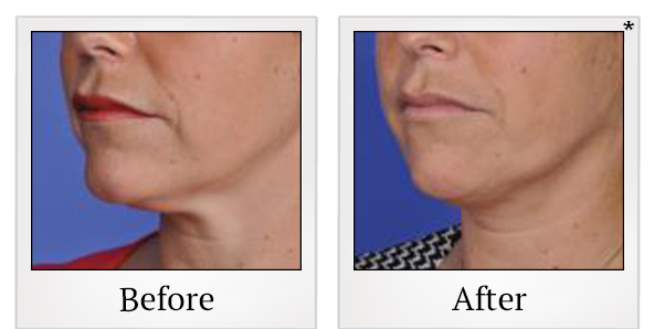 Before and After Photo 5 of Thermitight® treatment at SF Bay Cosmetic Surgery Medical Group in San Ramon