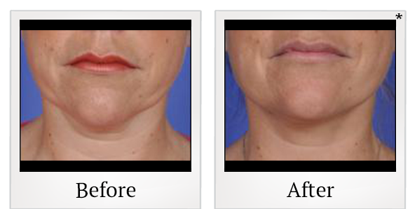 Before and After Photo 6 of Thermitight® treatment at SF Bay Cosmetic Surgery Medical Group in San Ramon