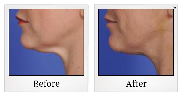 Before and After Photo 7 of Thermitight® treatment at SF Bay Cosmetic Surgery Medical Group in San Ramon