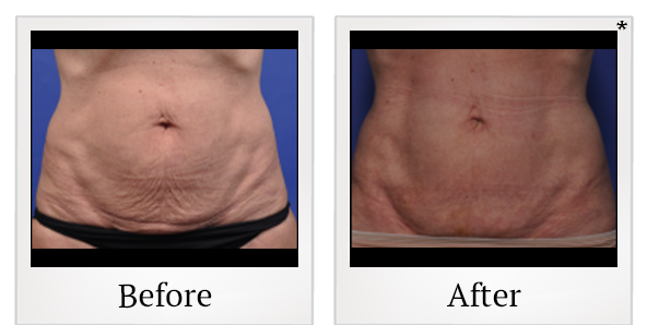Before and After Photo 8 of Thermitight® treatment at SF Bay Cosmetic Surgery Medical Group in San Ramon
