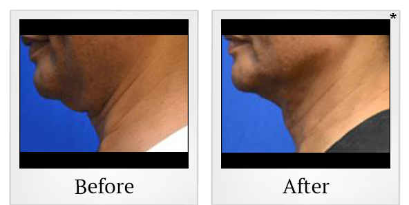 Before and After Photo 9 of Thermitight® treatment at SF Bay Cosmetic Surgery Medical Group in San Ramon