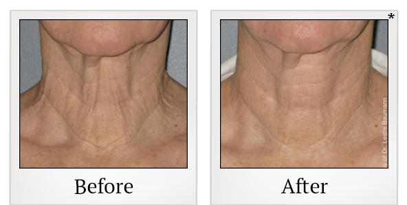 Before and After Photo 10 of Ultherapy treatment at SF Bay Cosmetic Surgery Medical Group in San Ramon