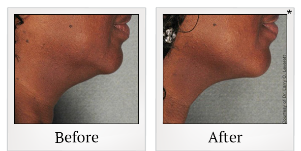 Before and After Photo 11 of Ultherapy treatment at SF Bay Cosmetic Surgery Medical Group in San Ramon