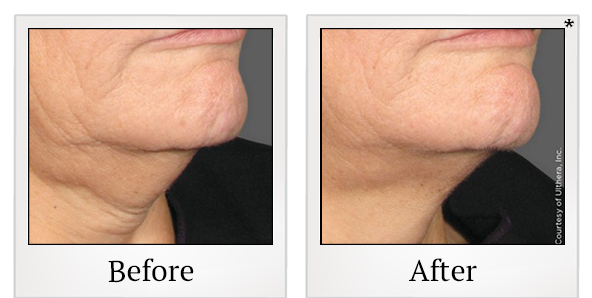 Before and After Photo 12 of Ultherapy treatment at SF Bay Cosmetic Surgery Medical Group in San Ramon