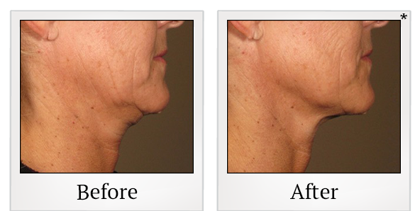 Before and After Photo 13 of Ultherapy treatment at SF Bay Cosmetic Surgery Medical Group in San Ramon