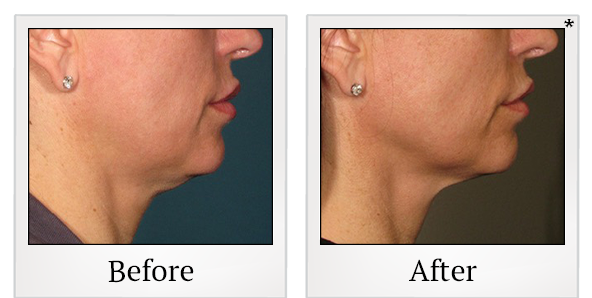 Before and After Photo 14 of Ultherapy treatment at SF Bay Cosmetic Surgery Medical Group in San Ramon