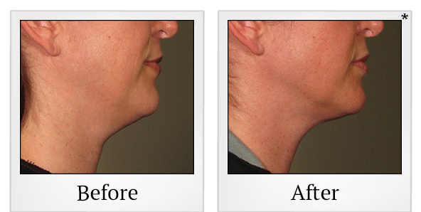 Before and After Photo 15 of Ultherapy treatment at SF Bay Cosmetic Surgery Medical Group in San Ramon