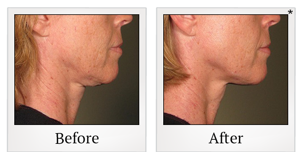Before and After Photo 16 of Ultherapy treatment at SF Bay Cosmetic Surgery Medical Group in San Ramon
