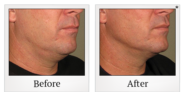 Before and After Photo 17 of Ultherapy treatment at SF Bay Cosmetic Surgery Medical Group in San Ramon
