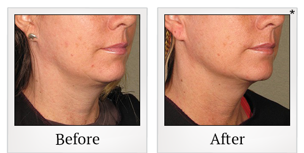 Before and After Photo 18 of Ultherapy treatment at SF Bay Cosmetic Surgery Medical Group in San Ramon