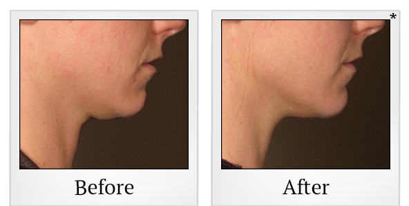 Before and After Photo 19 of Ultherapy treatment at SF Bay Cosmetic Surgery Medical Group in San Ramon