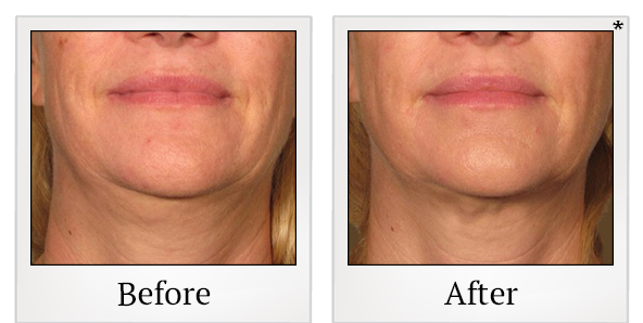 Before and After Photo 20 of Ultherapy treatment at SF Bay Cosmetic Surgery Medical Group in San Ramon