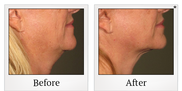 Before and After Photo 21 of Ultherapy treatment at SF Bay Cosmetic Surgery Medical Group in San Ramon