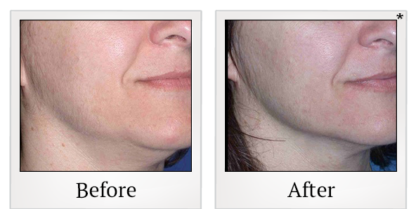 Before and After Photo 22 of Ultherapy treatment at SF Bay Cosmetic Surgery Medical Group in San Ramon