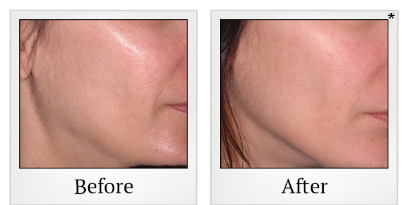 Before and After Photo 23 of Ultherapy treatment at SF Bay Cosmetic Surgery Medical Group in San Ramon