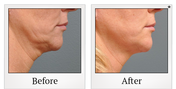 Before and After Photo 24 of Ultherapy treatment at SF Bay Cosmetic Surgery Medical Group in San Ramon