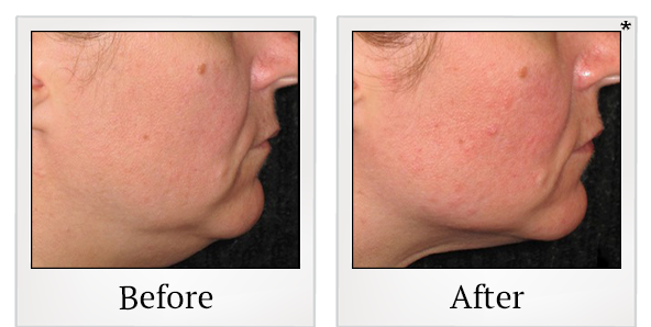 Before and After Photo 25 of Ultherapy treatment at SF Bay Cosmetic Surgery Medical Group in San Ramon