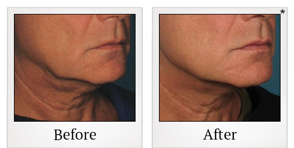 Before and After Photo 26 of Ultherapy treatment at SF Bay Cosmetic Surgery Medical Group in San Ramon