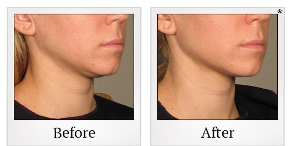 Before and After Photo 27 of Ultherapy treatment at SF Bay Cosmetic Surgery Medical Group in San Ramon