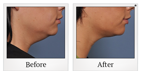 Before and After Photo 28 of Ultherapy treatment at SF Bay Cosmetic Surgery Medical Group in San Ramon